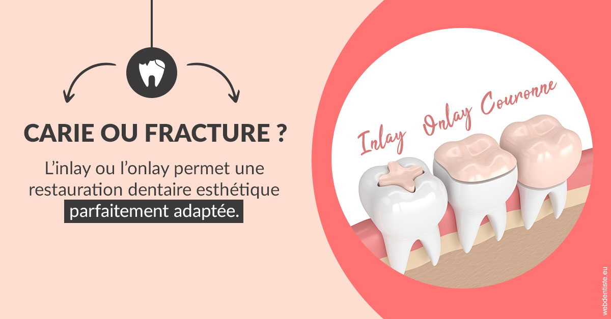 https://dr-grenard-annabelle.chirurgiens-dentistes.fr/T2 2023 - Carie ou fracture 2
