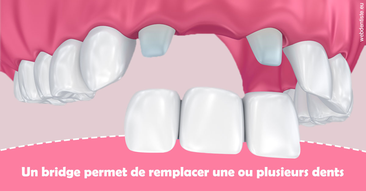 https://dr-grenard-annabelle.chirurgiens-dentistes.fr/Bridge remplacer dents 2