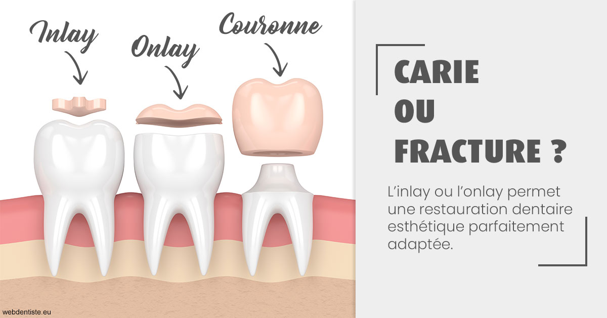 https://dr-grenard-annabelle.chirurgiens-dentistes.fr/T2 2023 - Carie ou fracture 1