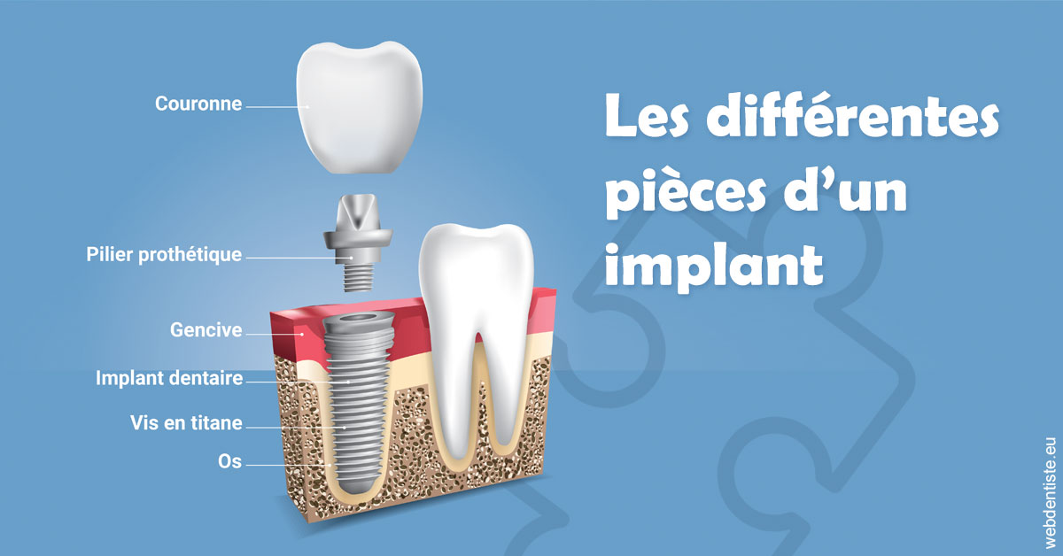 https://dr-grenard-annabelle.chirurgiens-dentistes.fr/Les différentes pièces d’un implant 1